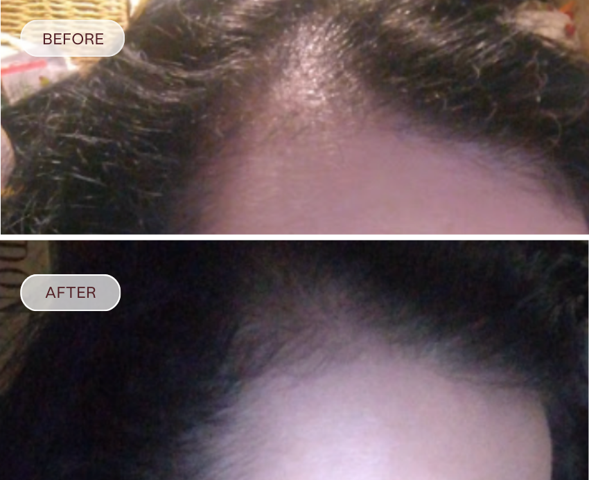 Before and after comparison of a person's scalp with hair growth.