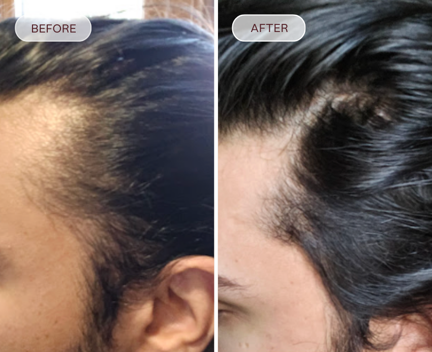 Before and after comparison of hair treatment on a person's scalp.