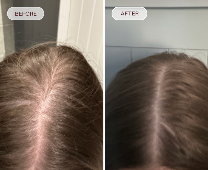 Before and after comparison of a person's scalp with hair growth.