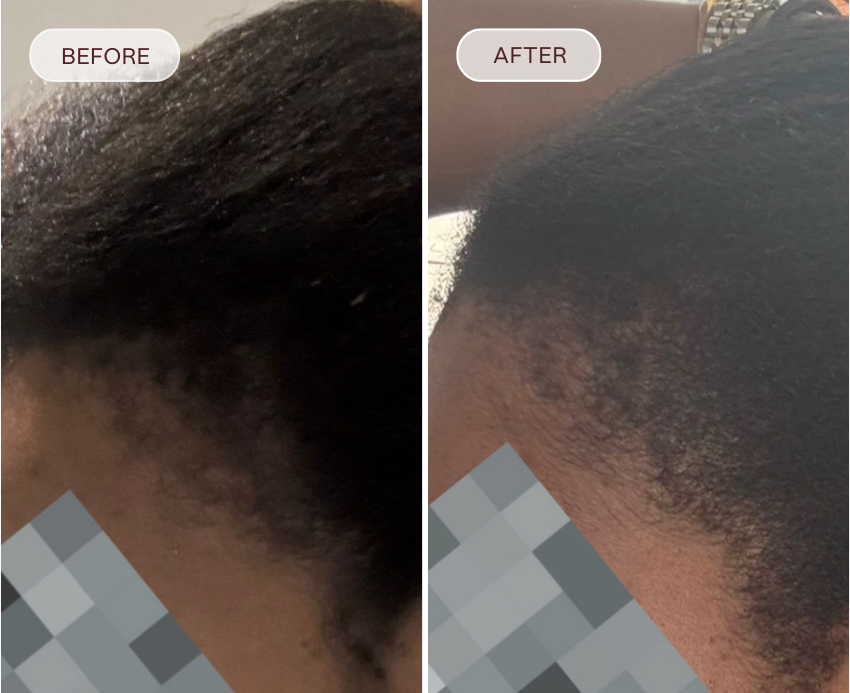 Before and after comparison of hair care product on a person's scalp.